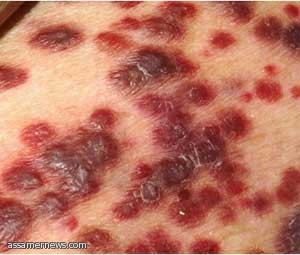 بكتيريا فتاكة آكلة للحوم البشر تنتشر في بريطانيا    