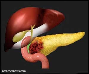 اكتشاف علاج لوقف سرطان البنكرياس    